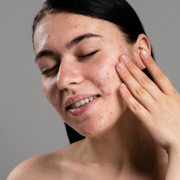 best place for chemical peel in bangalore